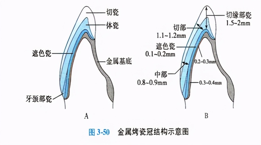 口腔金属冠与全瓷冠的区别,牙科医生讲义