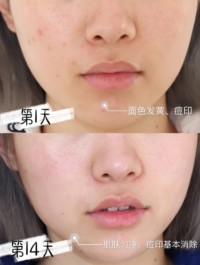 教你四个技巧拯救敏感肌,拿什么拯救敏感肌