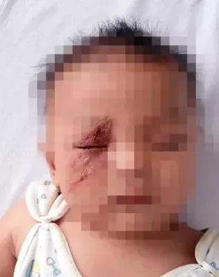 3岁女儿被毒虫“咬一口”差点毁容:这套实用防虫手册,记得收藏