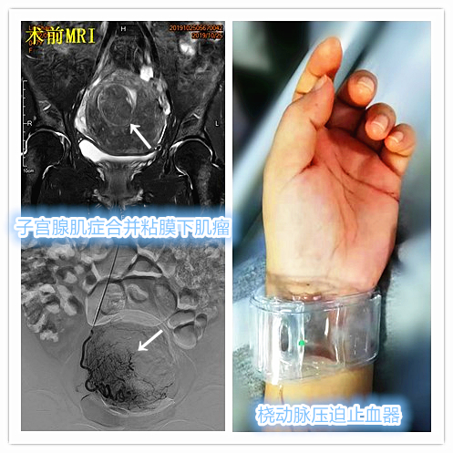 子宫腺肌症「不死的癌症」——介入栓塞来帮忙