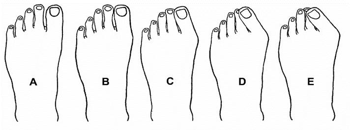 穿鞋脚疼没穿袜子,穿鞋脚不痛了