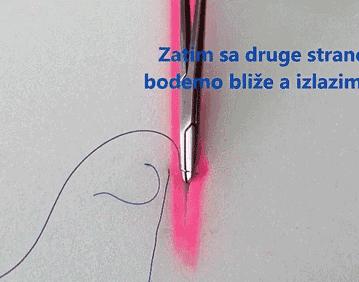 十种外科基本缝合方式详解,手术切口缝合有哪几种