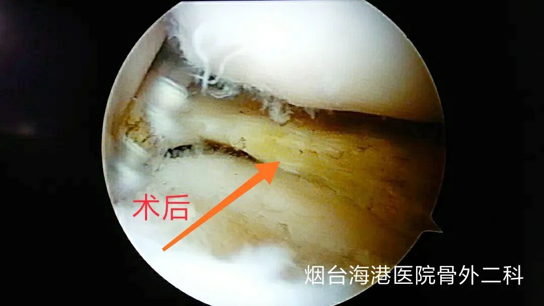 半月板手术导致骨性关节炎怎么办,关节镜治疗半月板损伤后遗症