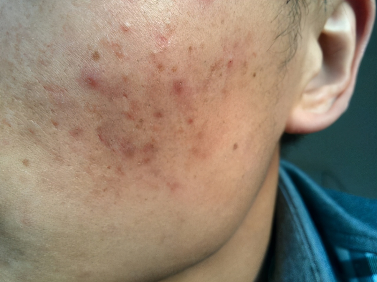 痘印表面好了里面没好,痘印发黑一直下不去用什么好