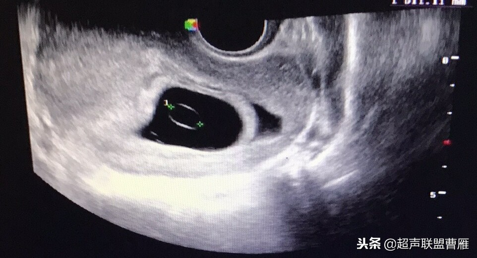 内见卵黄囊,卵黄囊肿瘤