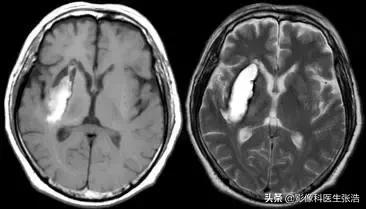 脑出血磁共振各个时期表现,脑出血的分期及磁共振影像学表现