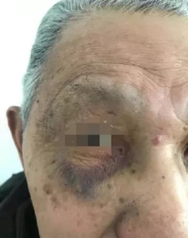 93岁老人被儿媳殴打住院后续,保姆长期殴打77岁瘫痪老人致骨折