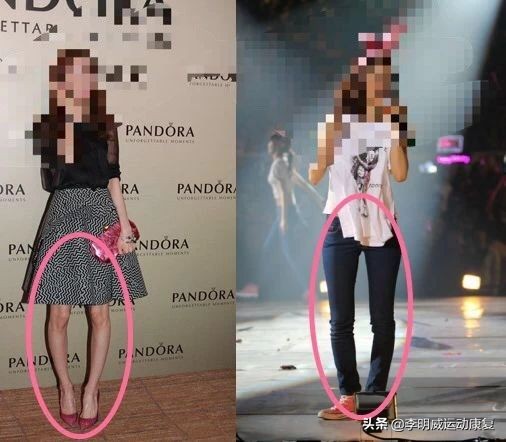 o型腿的自我鉴别及矫正方法,怎么知道o型腿是不是在慢慢变好