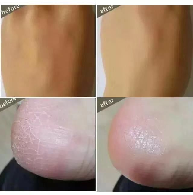 冬天皮肤干燥起皮屑用什么护肤品,一到冬天脸部干燥起皮补什么