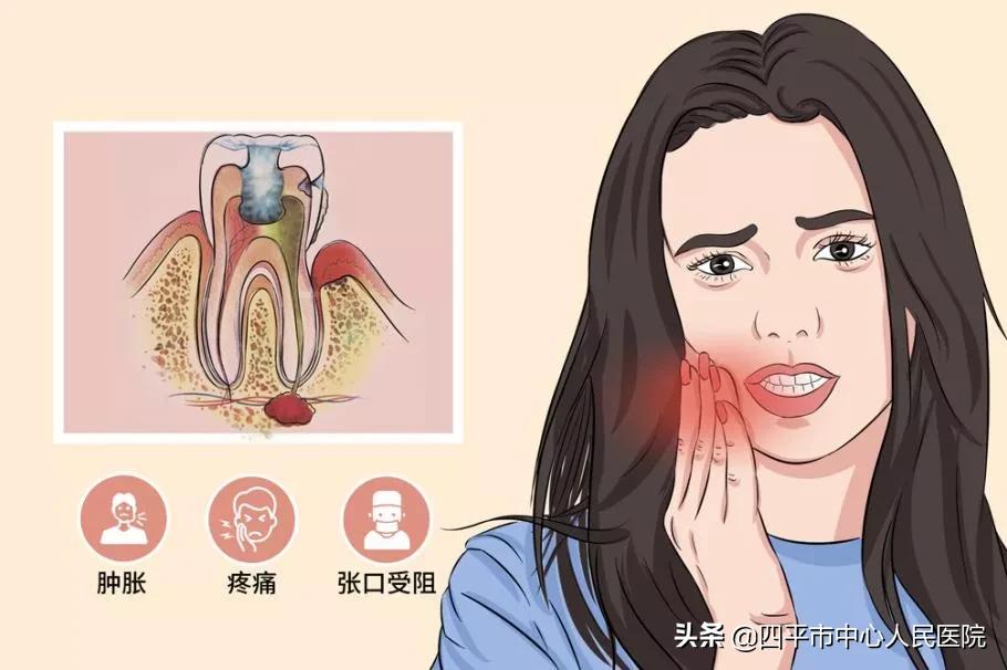 智齿冠周炎去口腔诊所会怎么处理,口腔科智齿冠周炎