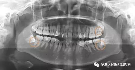 不想拔智齿但很疼怎么办,不想拔智齿想磨掉一部分怎么样