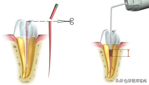 做了根管治疗的牙齿还能管多久,根管治疗不好的牙齿有必要拔掉吗