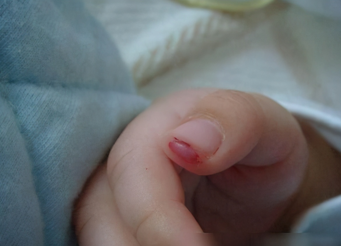 刚出生的宝宝剪指甲剪到肉怎么办,初生婴儿指甲抓破脸