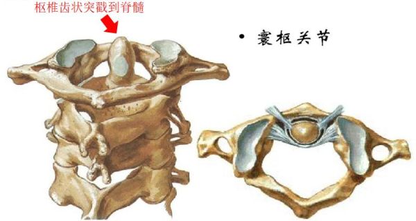 落枕是因为着凉吗,睡姿不正确导致的落枕怎么办