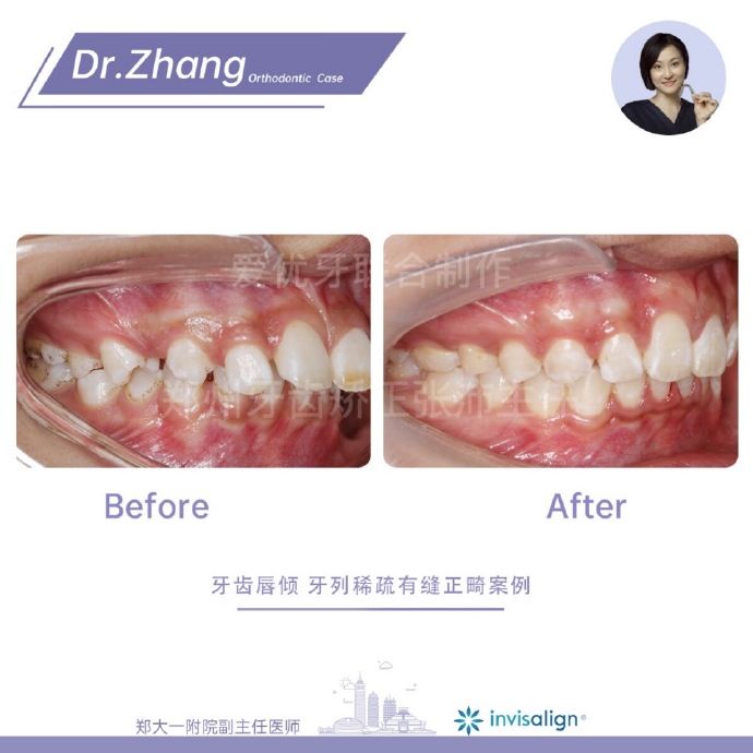 牙齿矫正郑州,郑州牙齿矫正案例合集