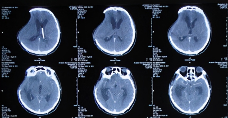 脑外伤开颅手术后脑积水,脑外伤手术后脑脊液鼻漏怎么治疗