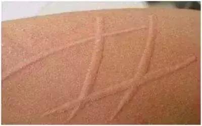 荨麻疹千万不要吃抗过敏的药,荨麻疹别不当回事小心伴随着肝炎