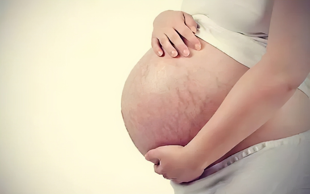 肥胖纹妊娠纹还有什么纹,肥胖纹或者生长纹怎么消除