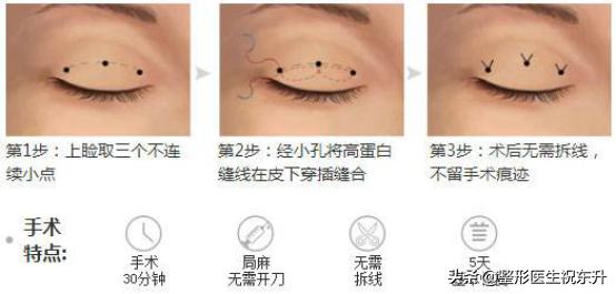 什么是韩式三点双眼皮,三点式双眼皮什么意思