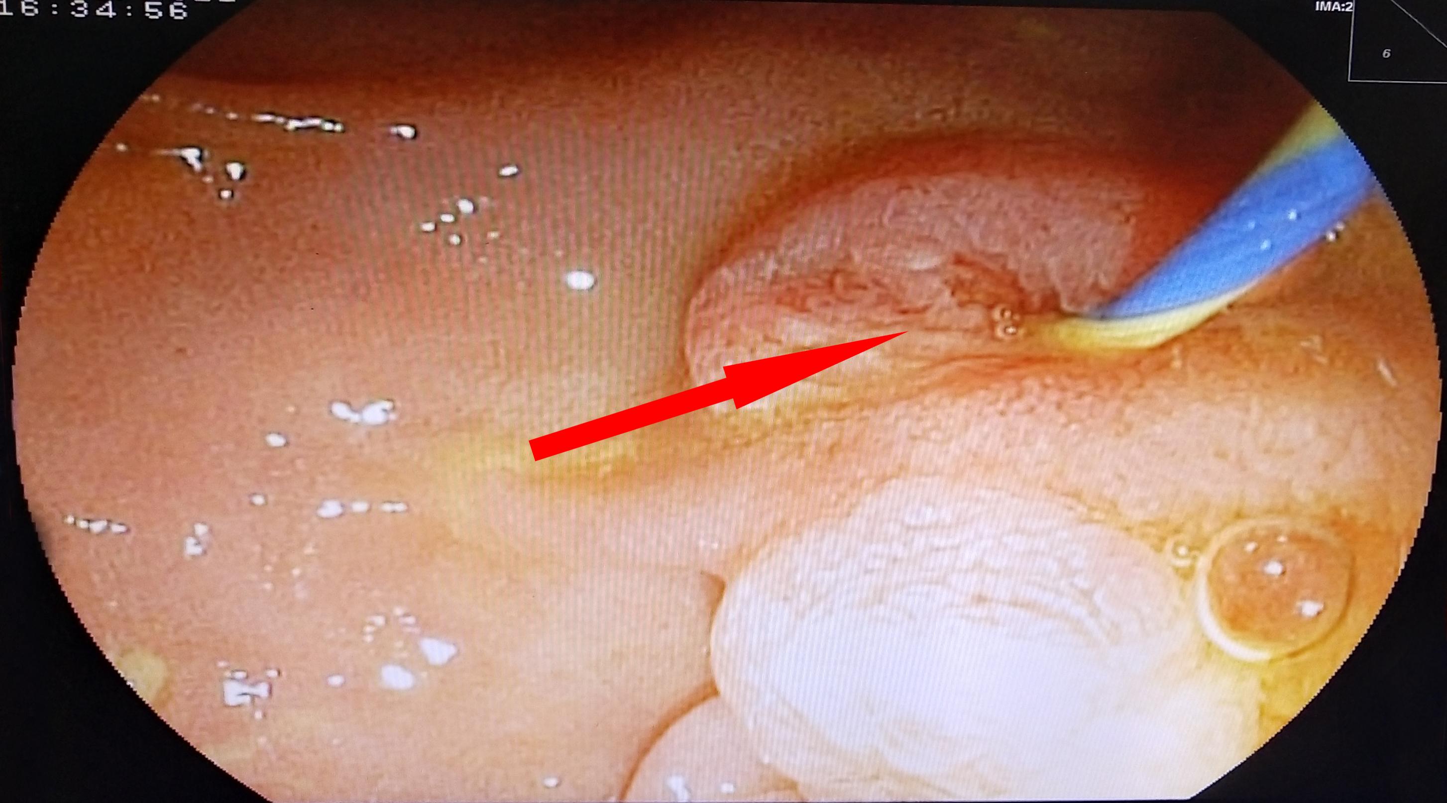 无创取胆结石,无创胆结石手术