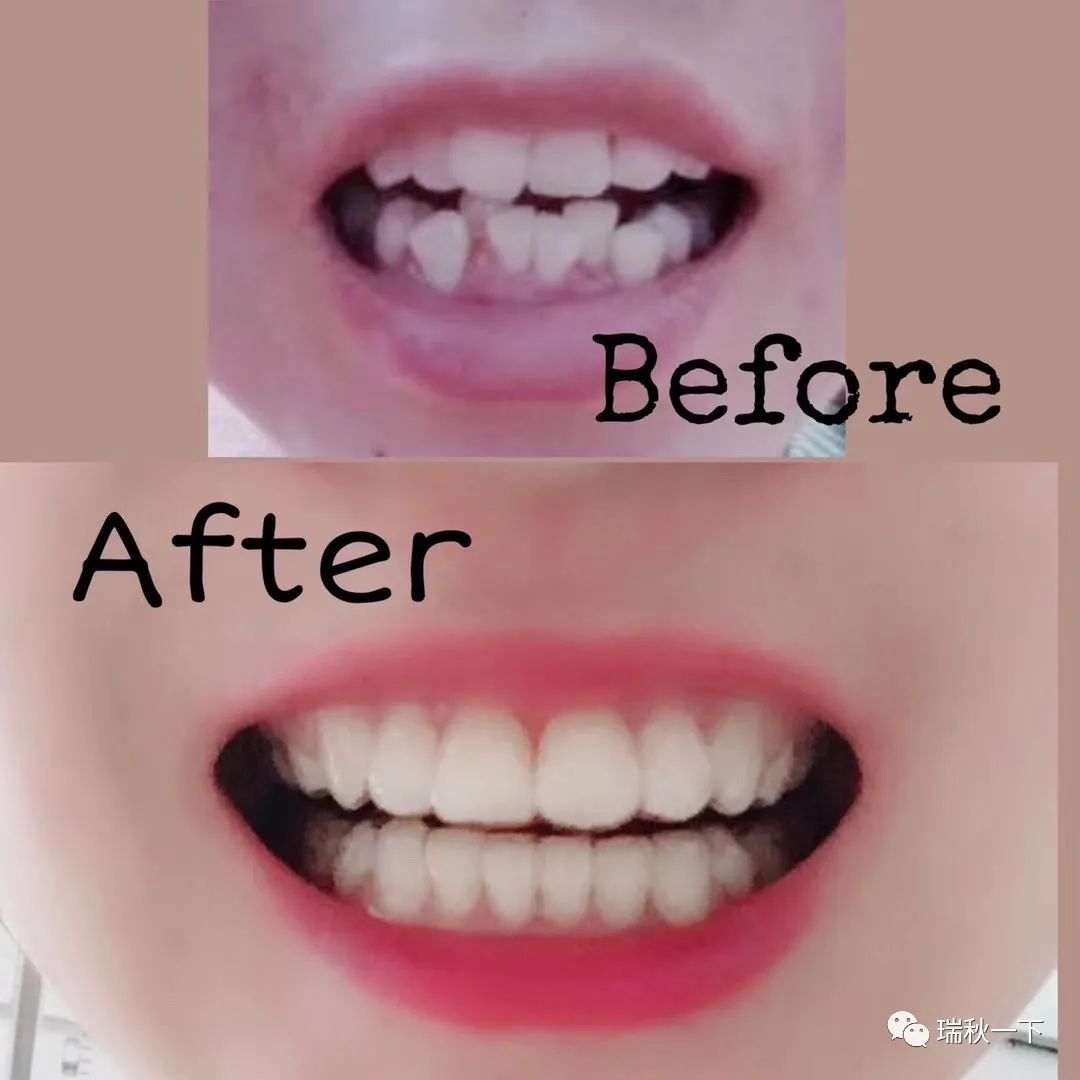 牙齿矫正,你后悔了吗?