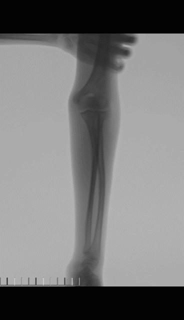 两个儿童前臂骨折争议病例之——元芳你怎么看