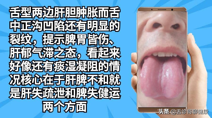 舌诊哥肝郁脾虚,乙肝肝郁脾虚舌象