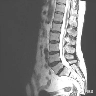小针刀扎到坐骨神经会瘫痪吗,小针刀会切断坐骨神经吗