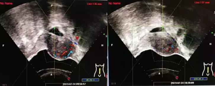 赞！不开刀不流血就把手术做了，赤峰市肿瘤医院迈入微无创时代