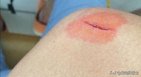感染破伤风的伤口有什么特征,泡温泉有伤口会感染破伤风吗