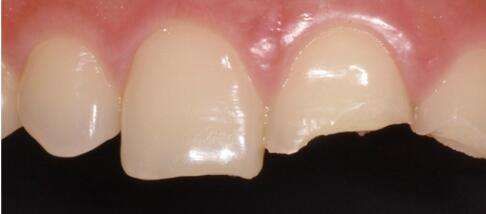 露神经真假辨别,真假露得清颜色