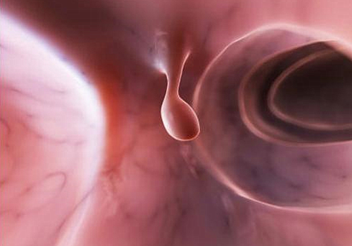 狗狗息肉不明显需要处理吗,狗狗眼睛长了息肉保守治疗