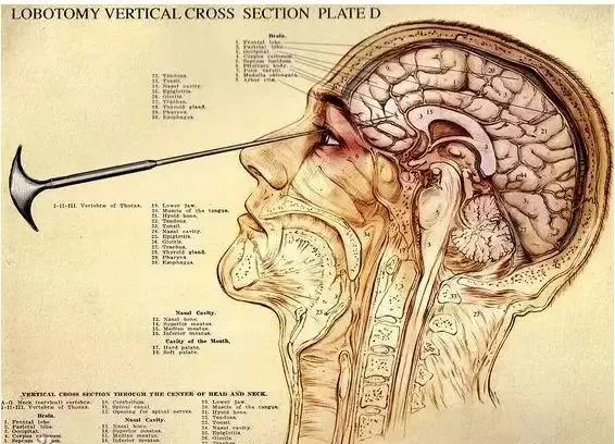 电击、开颅、切脑,为了治病精神病患者受过多少罪