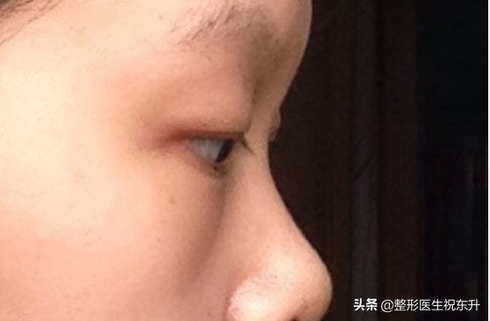 填泪沟可以用自己眼袋填吗,填泪沟可以解决眼袋问题吗