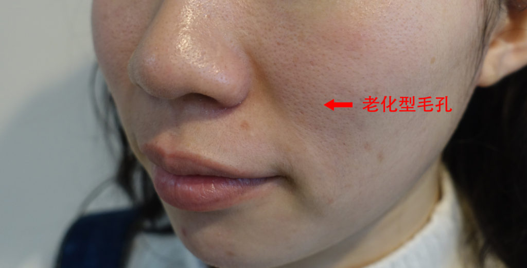 男生怎么缩小毛孔,毛孔缩小的过程图