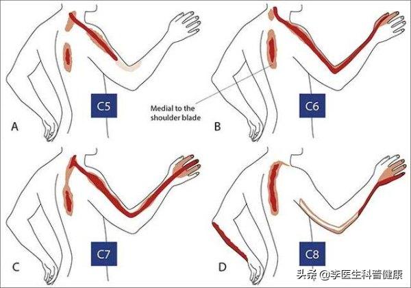 你有肩颈痛的症状吗,肩膀疼的原因和解决方法