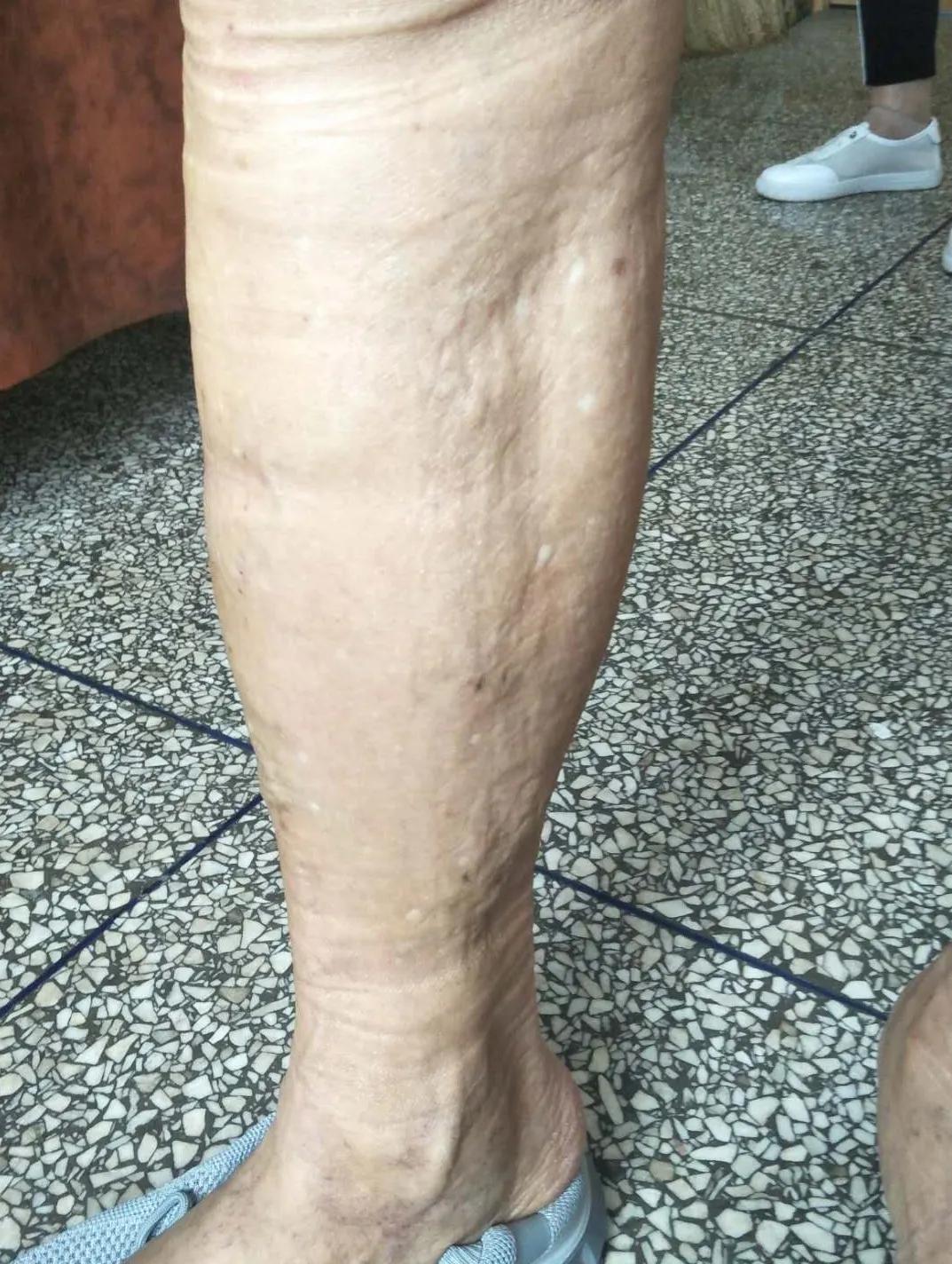 河北静脉曲张微创手术,邢台静脉曲张手术多长时间治好