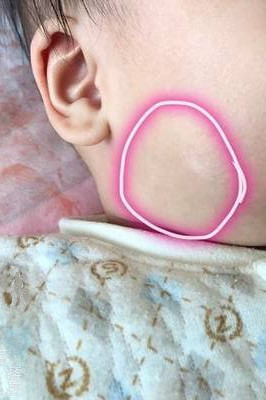 皮肤的小白点怎么解决,皮肤上小白点很痒图片