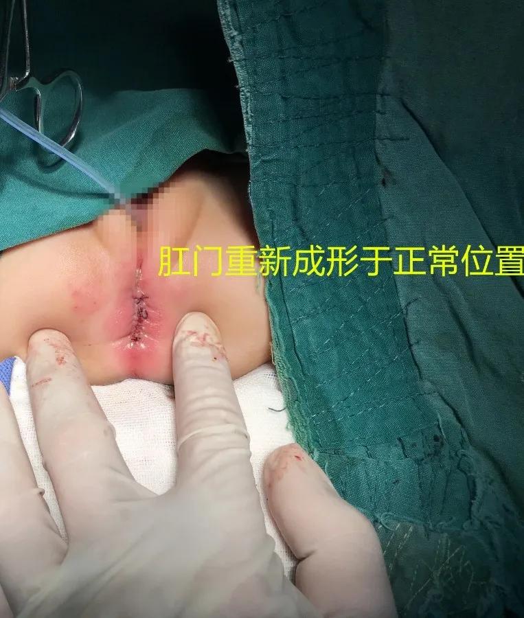 女婴出生没有双腿被狠心父母抛弃,宝宝出生半年才发现无肛