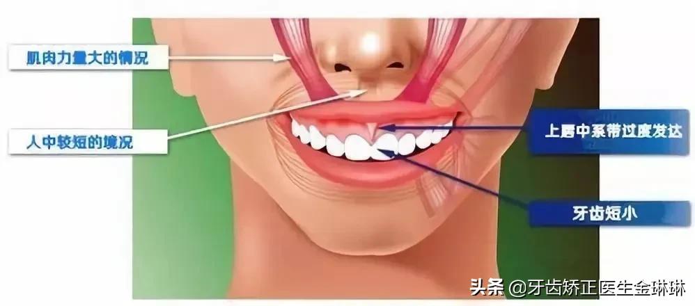 露龈笑对颜值有多大影响,颜值杀露龈笑