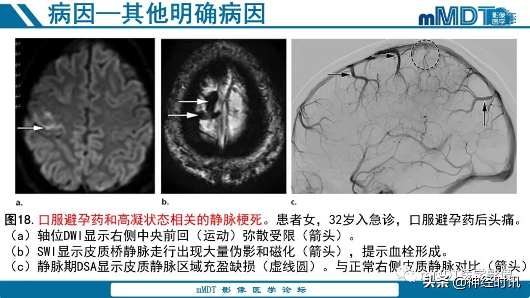 缺血性脑卒中护理课件,缺血性脑卒中讲课ppt