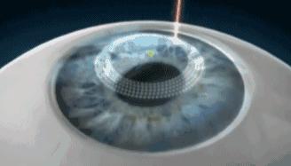 近视眼手术后的亲身经历2020,近视眼手术10年后的亲身经历