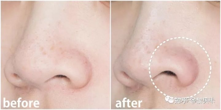 公认最好用的去黑头神器,网红推荐去黑头神器