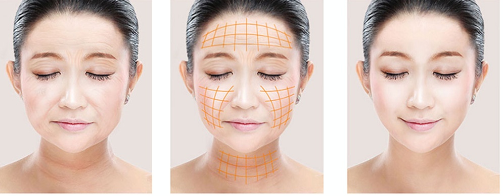 注射除皱玻尿酸和除皱针要怎么选,注射除皱和填充