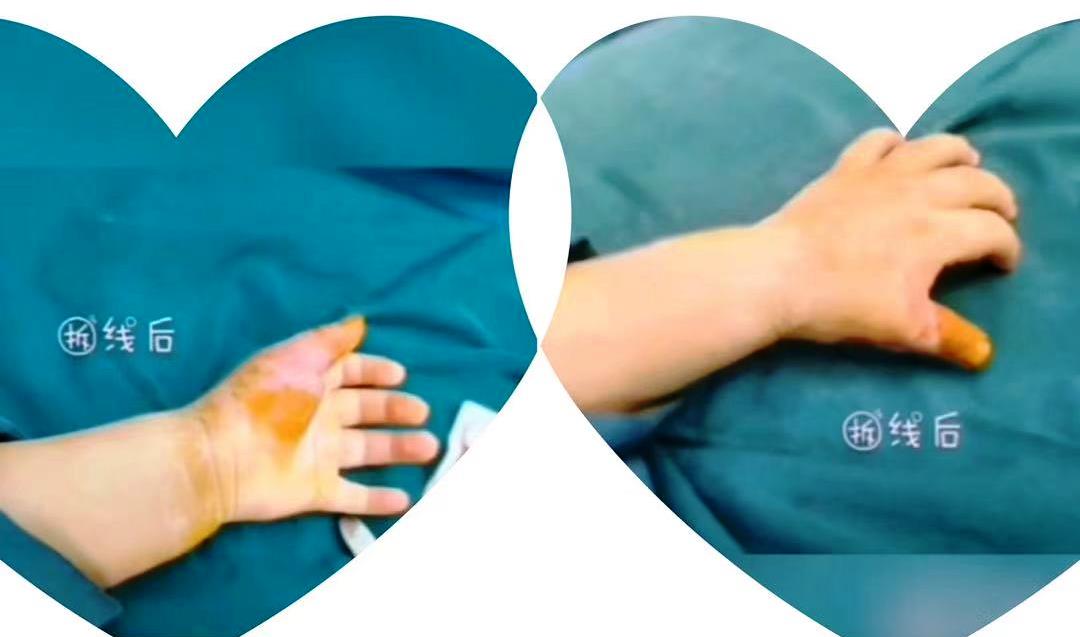 灏忓澶氭寚鐣稿舰鎬庝箞娌荤枟,鍎跨澶氭寚鐣稿舰鏈夊繀瑕佸垏闄ゅ悧