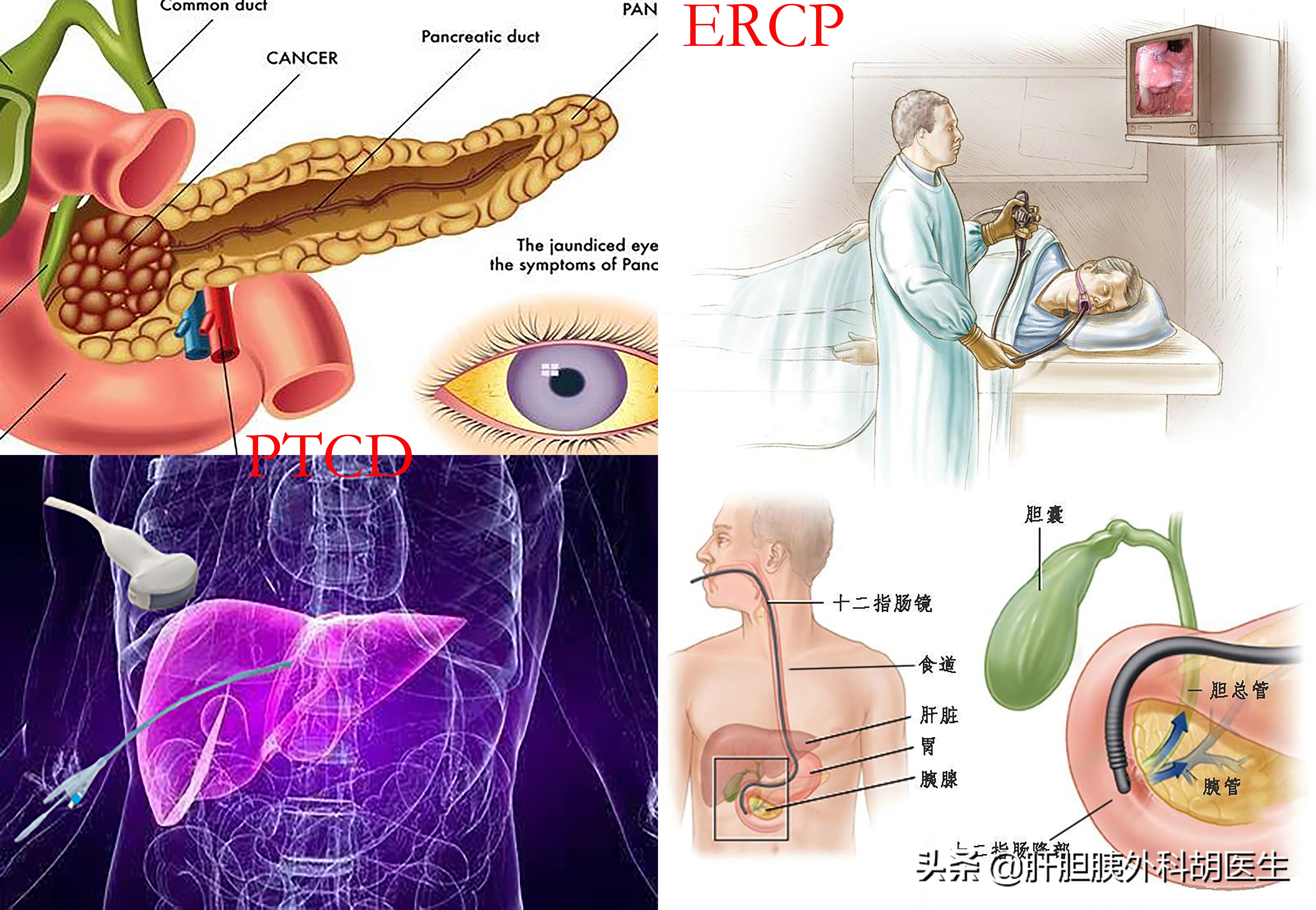 胰腺癌手术后肝转移出现黄疸,胰腺癌出现黄疸是早期还是晚期