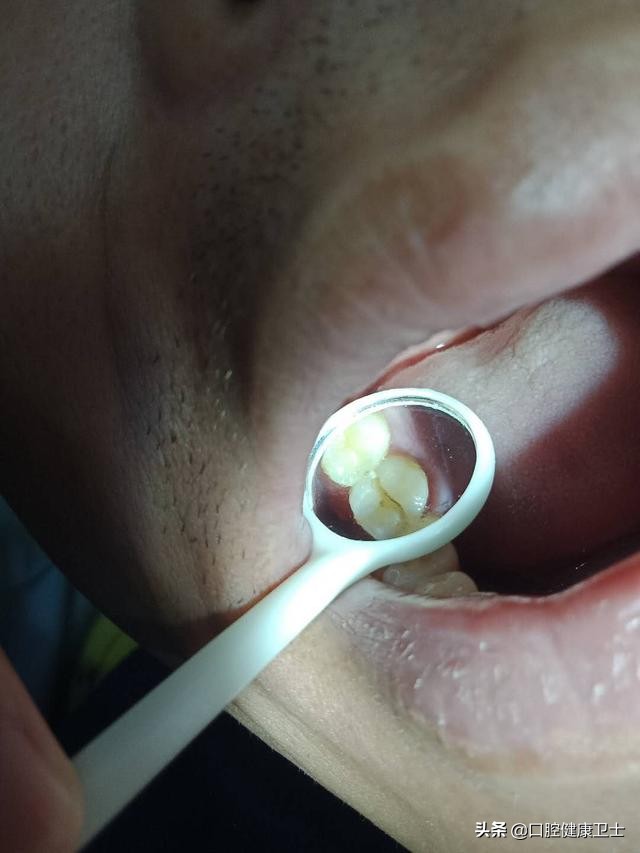 牙齿劈裂怎么处理,牙齿劈裂的补救方法