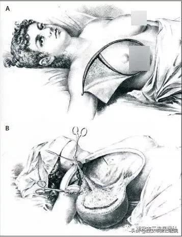 乳腺癌治疗史的不断演进,中医讲乳腺癌的真实故事