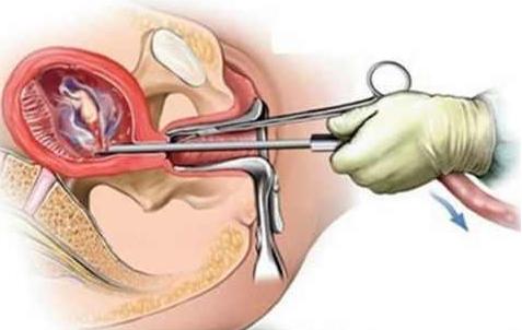 女性刮宫和清宫有什么区别？