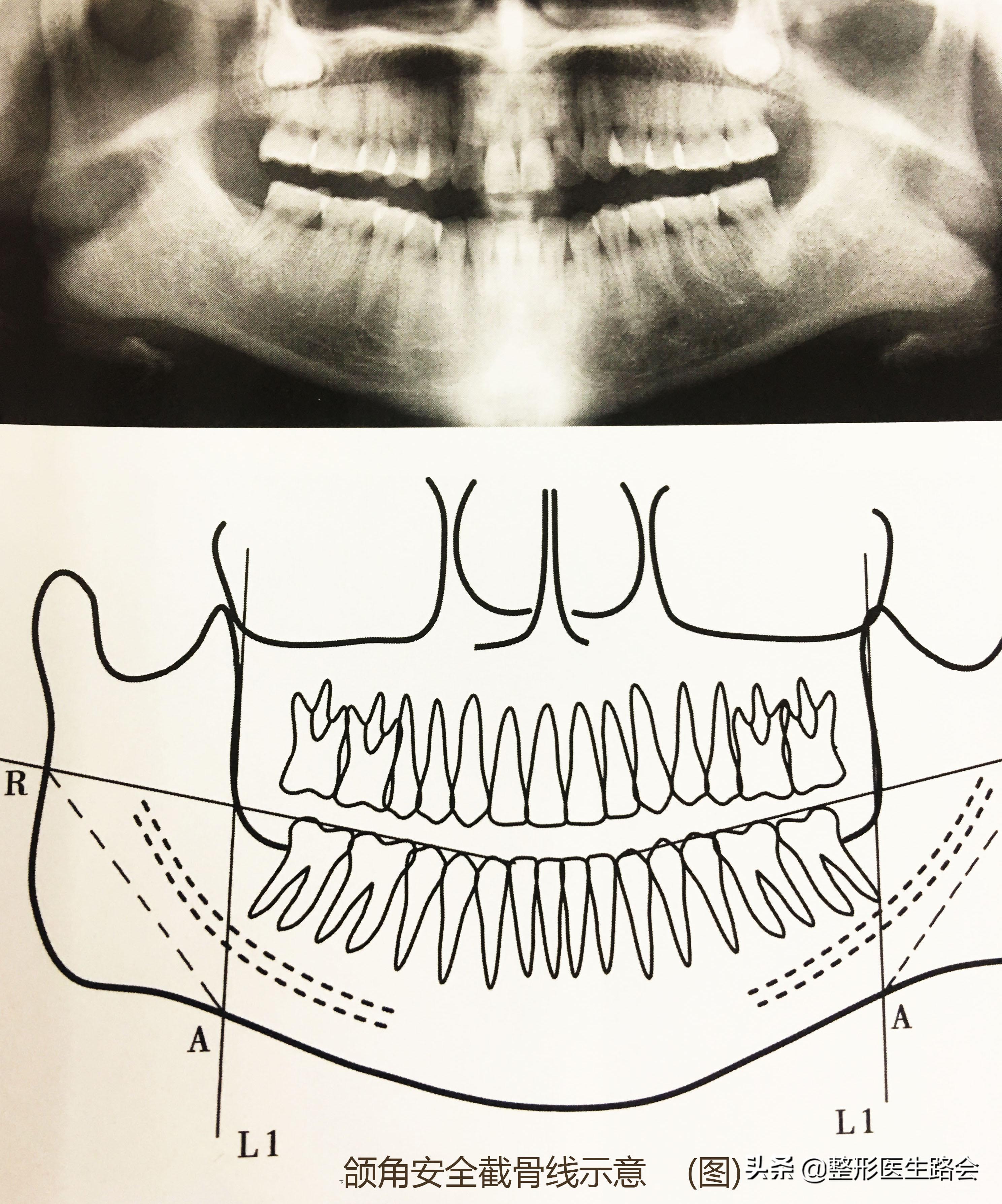 蘑菇怎么变成鹅蛋脸,国字脸磨骨成瓜子脸多少钱
